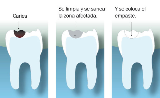 para qué se coloca un empaste