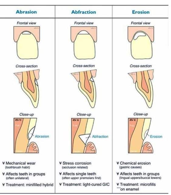 infografia abrasion