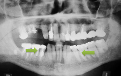 Tipos de anodoncia