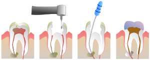 procedimiento endodoncia