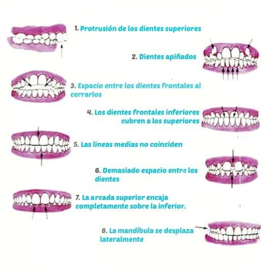 signos de maloclusión