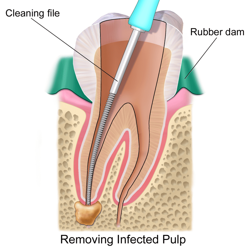 endodoncia