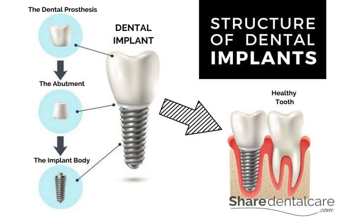 estructura de un implante dental infografia