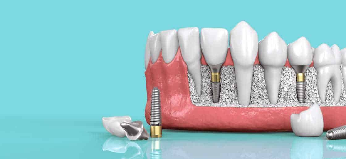 ventajas de los implantes dentales