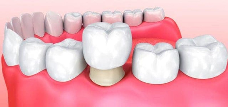 Fundas de Tipos de coronas dentales | Clínica Dental Urbina