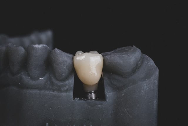 Preguntas frecuentes sobre los implantes dentales
