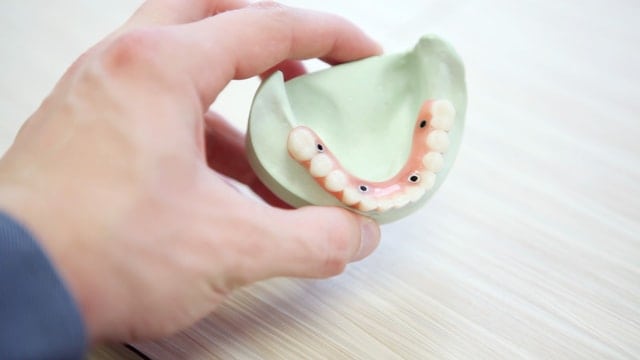 implantes dentales mandíbula