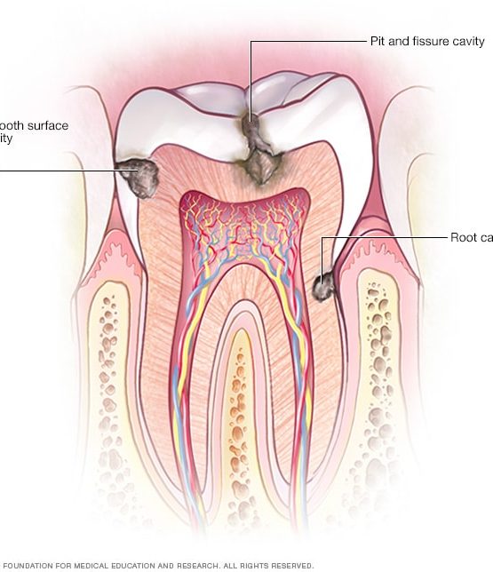 tipos de caries