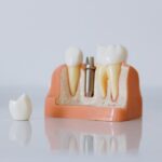 Maneras de cuidar los implantes dentales