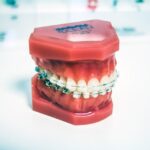 Brackets Transparentes Tipos, funcionamiento y ventajas