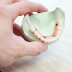 Dentadura fija sobre 4 implantes: precio y consideraciones